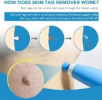 Acrochordon Skin Remover Kit - Image 6