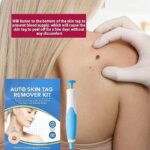 Acrochordon Skin Remover Kit - Image 3